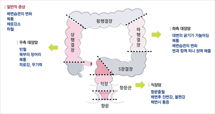 일반적 증상 - 배변습관의 변화,복통,체중감소,하혈 우측 대장암 - 빈혈,복부의덩어리,복통,피로감,무기력 좌측 대장암 - 대변의 굵기가 가늘어짐, 복통, 배변습관의변화, 변과 함께 피나 점액 배출 직장암 - 항문출혈, 배변후 잔변감, 불편감, 배변시 통증 일반적 증상 - 배변습관의 변화,복통,체중감소,하혈 우측 대장암 - 빈혈,복부의덩어리,복통,피로감,무기력 좌측 대장암 - 대변의 굵기가 가늘어짐, 복통, 배변습관의변화, 변과 함께 피나 점액 배출 직장암 - 항문출혈, 배변후 잔변감, 불편감, 배변시 통증